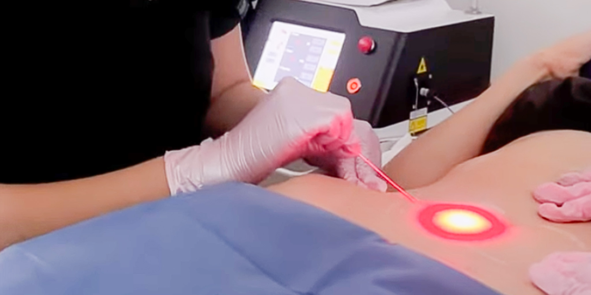 Endolifting Corportal