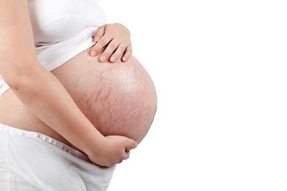 Estrías en el embarazo: prevención y tratamiento 