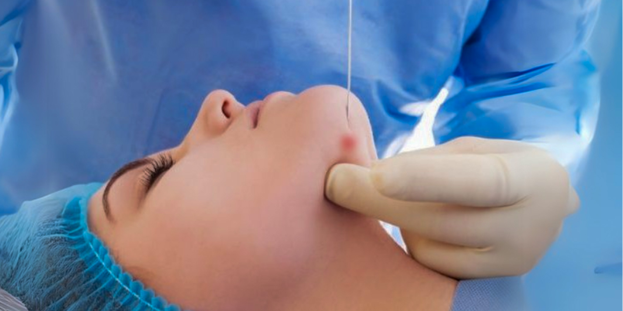 Facial Endolifting