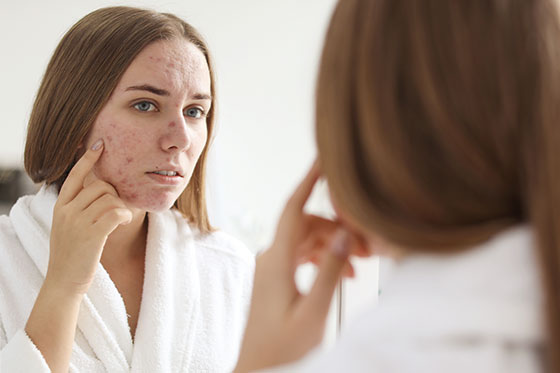 Cómo quitar las manchas de acné en la cara