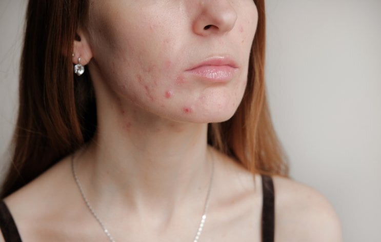Cómo afecta emocionalmente el acné