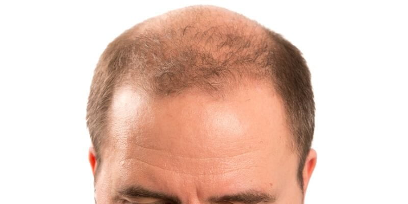 tipos de alopecia