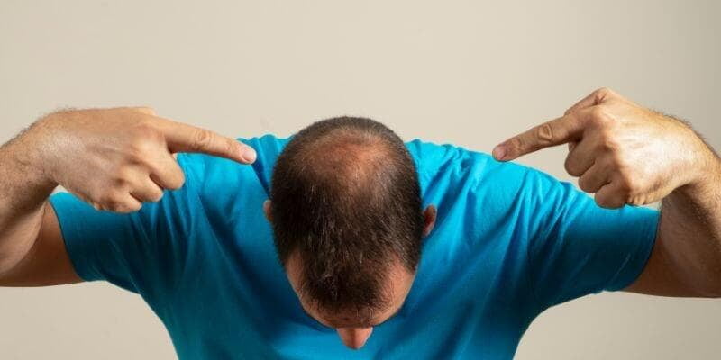 causas comunes alopecia