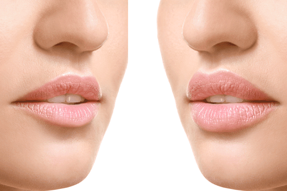 Antes y después relleno de labios