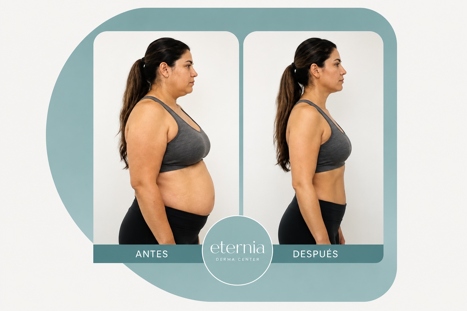Antes y después de paciente en programa de medicina metabólica para pérdida de peso en Quito.