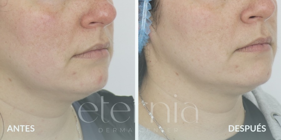 Antes y después de tratamiento para rosácea y enrojecimiento facial