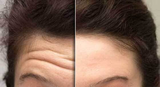 antes y despues tratamiento arrugas