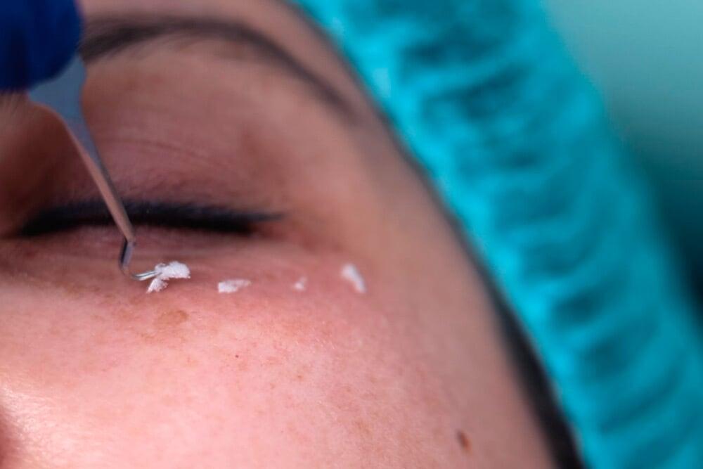 Cristales líquidos: Rejuvenecimiento facial no invasivo