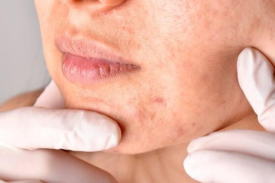 Microneedling acné