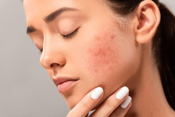 ¿Qué tipos de manchas en la piel existen? 