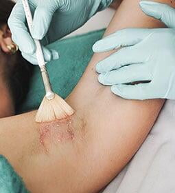 Tratamiento eliminar manchas en la piel