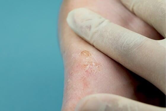 Infeccion piel hongos quito