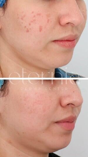 Antes y después tratamiento acné