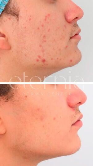 Antes y después acné