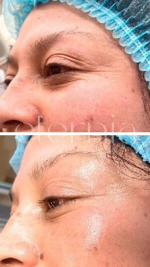 antes y despues tratamiento arrugas 2