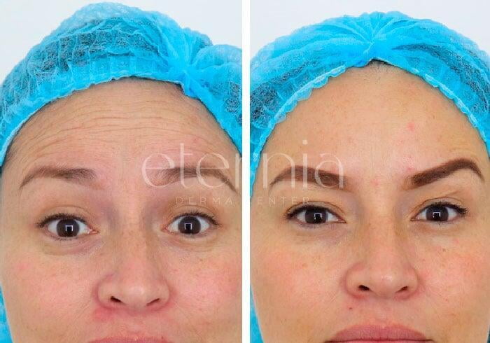 tratamiento arrugas antes y despues 2