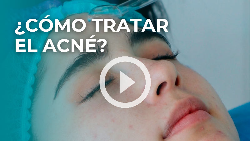 Quitar acné Quito